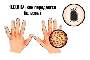 Чесотка: как передается болезнь? Чесотка: как передается болезнь?.